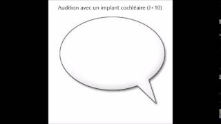 Comment on entend avec un implant cochléaire  Vidéo n°4 Normal J0 J10 J30 [upl. by Nareht]