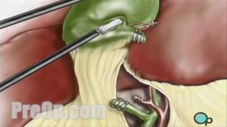 Patient Education Gallbladder Removal Laparoscopic Surgery PreOp® [upl. by Nirok372]