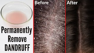 How to cure dandruff permanently naturally at home [upl. by Nils503]