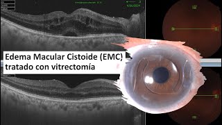 Edema Macular Cistoide EMC  Edema Macular Quístico  Vitrectomía  IrvineGass Syndrome [upl. by Willing]