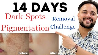 Top 5 VitaminC Serum to remove Pigmentation amp Dark Spots [upl. by Ydnim]