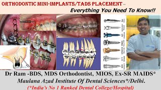 Complete Updated Clinical Guide for Orthodontic Mini ImplantsTADs Placement Fully explained DrRam [upl. by Atinrahs]