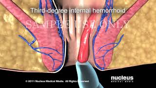 Hemorrhoid Classification System  Types of Hemorrhoid Surgery [upl. by Eniawed226]