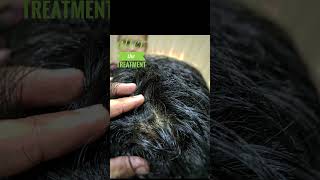 Case of Alopecia areata cure with homoeopathic medicine homoeopathy holistichealth india [upl. by Notniw710]