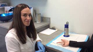 Wart Removal Using Liquid Nitrogen [upl. by Cl]