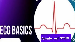 ECG Basics  Anterior Wall Myocardial Infarction  ECG Changes in Anterior STEMI [upl. by Notslah]