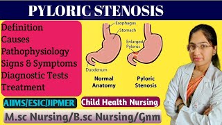 Pyloric Stenosis in Pediatric Nursing  Projectile Vomiting  Causes  Pathophysiology  Treatment [upl. by Ahseiyt]