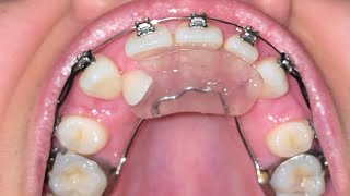 Upper Braces Time Lapse  15 Month Update  Adult Braces [upl. by Leach194]