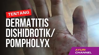 Dermatitis dishidrotik  Pompholix [upl. by Martyn493]