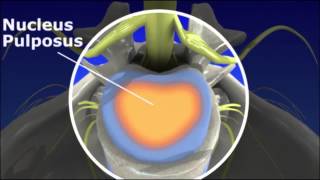 Herniated Disc  Pain Management [upl. by Shaya]