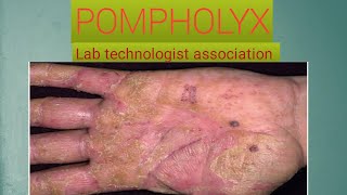 Everything you know about Pompholyx disease [upl. by Marlow]