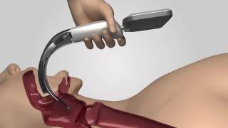 Video Laryngoscope iS3 L training video [upl. by Madson760]