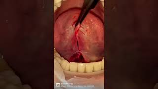 NEW🔥🔥🔥 Frenectomy  removal of a frenulum 🦷 Doctor Marta Siewert  Gutowska [upl. by Cordelie]