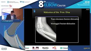 Malunion and nonunion of proximal ulnar fractures V Kontogeorgakos [upl. by Josephson5]