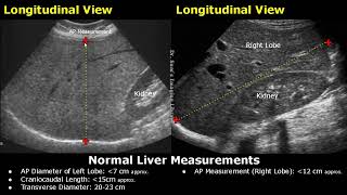 How To Measure Liver On Ultrasound  Craniocaudal Length Transverse Volume amp AP Measurements USG [upl. by Salohcin]