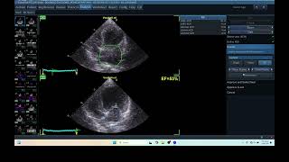 IQ 279 AFI LA HEPATOMA ECHOPAC ANALYSIS ECHOCARDIOGRAPHY [upl. by Yornek]