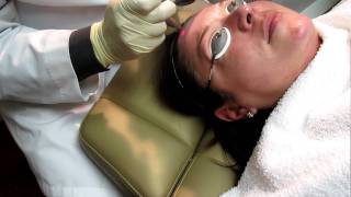 lite laser peel with fotona erbium laser [upl. by Oremoh]