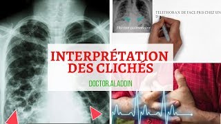 Fibrose pulmonaire  Comment Interpréter un cliché [upl. by Nimaj]