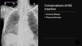 NG tube complications [upl. by Corabella]