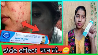 Benzoyl Peroxide Gel 25 Review In Hindi  Uses And Side Effect  miss glossy girl [upl. by Leavitt]