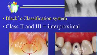 Dr GV Blacks Classification of Dental Caries and Restorations [upl. by Nnire151]