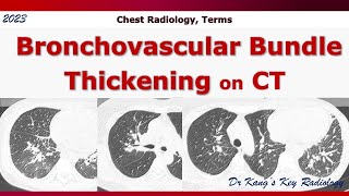 Bronchovascular bundle thickening on CT [upl. by Raff]