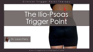 The Psoas Trigger Point [upl. by Nicolis]