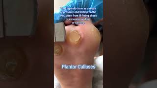 How To Remove Corns Plantar Calluses 😱😆 shorts callusremoval plantarcalluses [upl. by Anallij297]