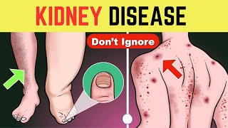 Chronic Kidney Disease CKD  kidney Disease Symptoms Prevention Tips [upl. by Jehu992]