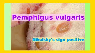 pemphigus vulgaris [upl. by Elleinod439]