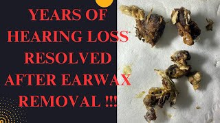 YEARS Of Hearing Loss RESOLVED After This SATISFYING Earwax Removal MUST WATCH Video [upl. by Annohsak]