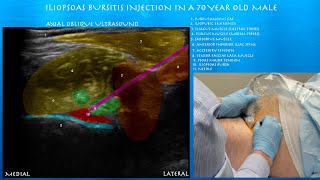 Ultrasound Guided Iliopsoas Bursts Injection by probeultrasound [upl. by Mosira]