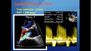 Elementi di ecocardiografia VII video valvulopatia aortica [upl. by Ennovahc832]