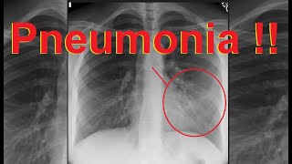 مظهر ذات الرئة على صورة الصدر  How to detect pneumonia on CXR [upl. by Nylegna]