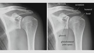 Shoulder Radiographic Evaluation [upl. by Atem]