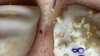 Loan Nguyen Acne Treatment 04 The best Remove acne [upl. by Shelley956]