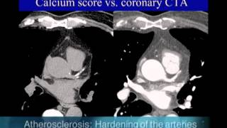 UCSF Radiology Calcium Scoring vs Coronary CTA Scan [upl. by Couture]