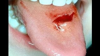 management of tongue lacerations [upl. by Peer]