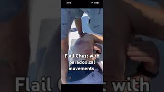 Flail Chest with paradoxical movements of ribs after the chest trauma [upl. by Gaughan]