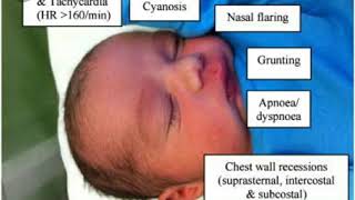 Hyaline membrane diseaserisk factor clinical features sign and symptoms [upl. by Rech]