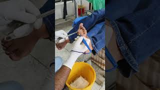 Full procedure of cauterization in Plantar corns [upl. by Htesil147]