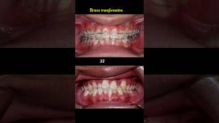 Cross bite braces transformation braces orthodontist dentist [upl. by Iroak]