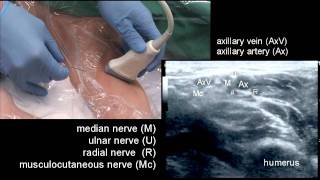 The Axillary Block [upl. by Hadnama]