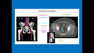 CT Anatomie vom Becken  Strahlentherapie Prof Hilke Vorwerk [upl. by Newmann594]