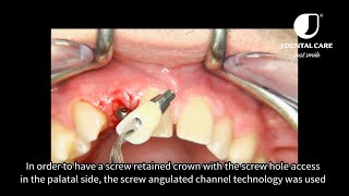 The JD screw angulated channel technology a new access to aesthetic a step by step video [upl. by Ennairrac]