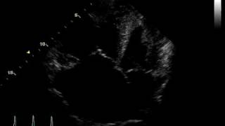 ACUTE PULMONARY HEART DISEASE  THROMBUS PULMONARY ARTERY [upl. by Mirella]