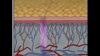 Phases of Wound Healing Pt 2  Wound Care Management  WoundEducatorscom [upl. by Nylednarb884]