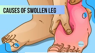 Causes of leg swelling DVTCELLULITISGANGRENELYMPHEDEMA amp more  Medicotes [upl. by Kcajyllib]