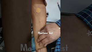 Mantoux Test  Tuberculin Skin Test  TBTest infectionBodyMTBPCRTBGOLD [upl. by Lelah444]