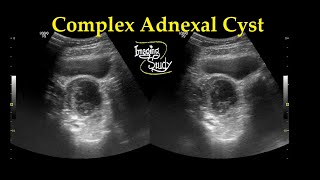 Complex Adnexal Cyst  Ultrasound  Case 27 [upl. by Crooks]